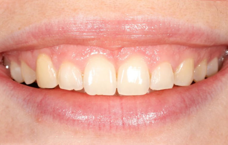 Invisalign-after