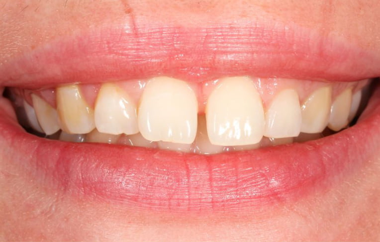 Invisalign-before