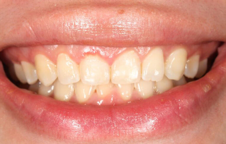 Invisalign-after