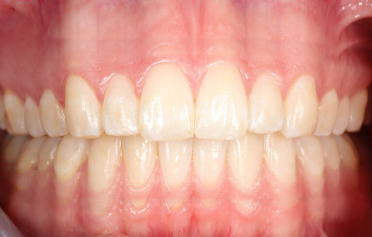 Invisalign-after