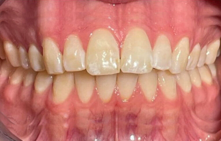 Invisalign-before