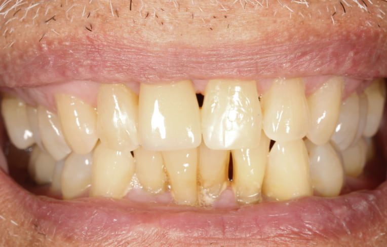 Smile makeover after