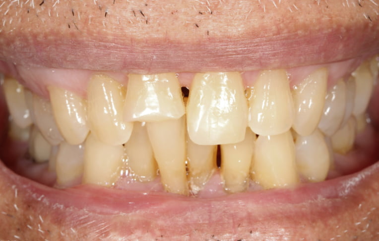 Smile makeover before