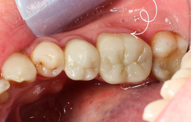 Crown-and-Bridge-after
