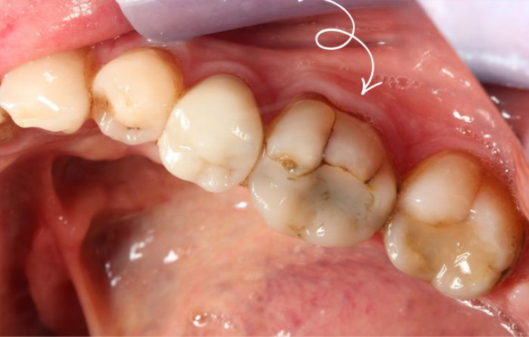 Crown-and-Bridge-before
